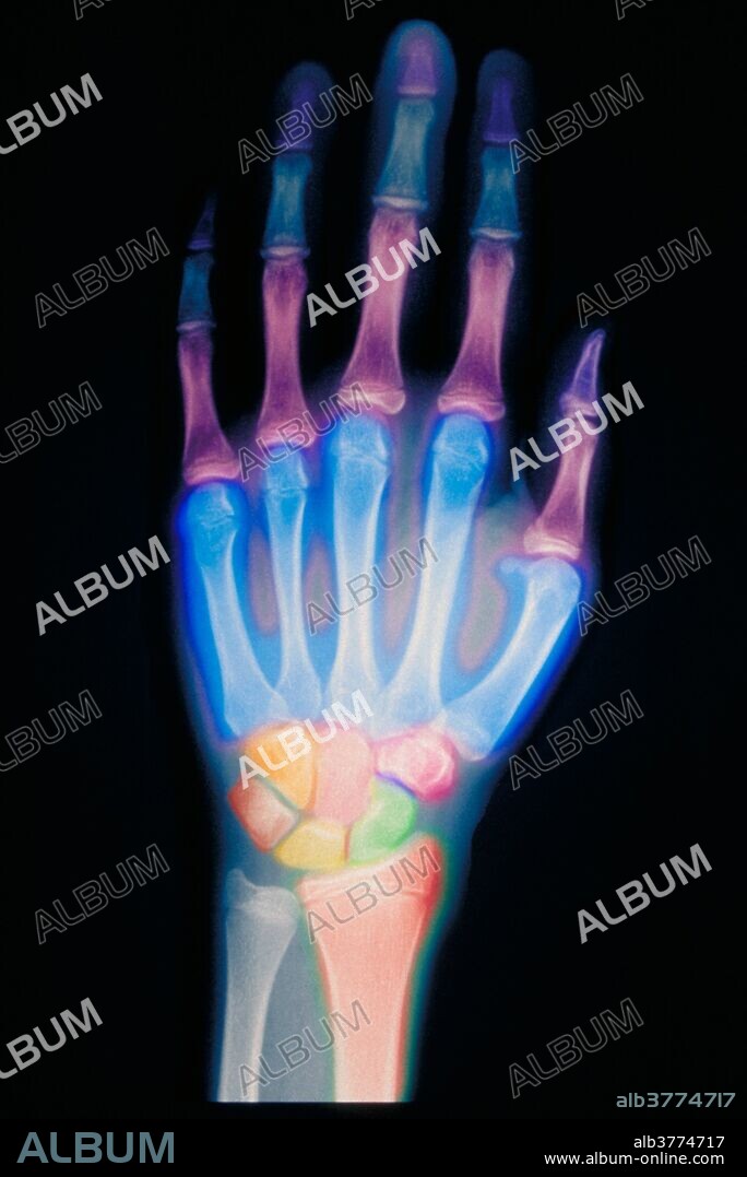 Hand x-ray of the bone development of a 12 year old child.