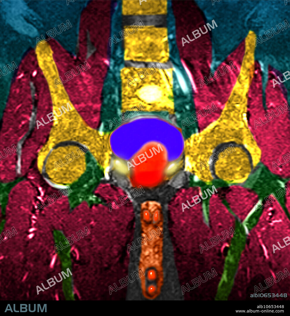 This colour enhanced coronal (frontal) view of the male pelvis was obtained using Magnetic Resonance Imaging (MRI). The bony pelvis and lower lumbar vertebrae (spine) are shown in yellow. The oval blue structure in the middle of the image is the urinary bladder. The bright red structure in the center of the image which partially covers the urinary bladder (blue) is a markedly enlarged prostate gland. The elongated orange structure is the penis. The focal rounded structures within the penis represent the corpora cavernosa of the penis. The green olive shaped structures on either side of the prostate gland (red) are the spermatic cord structures. The muscles of the pelvis and upper thighs are deep red.