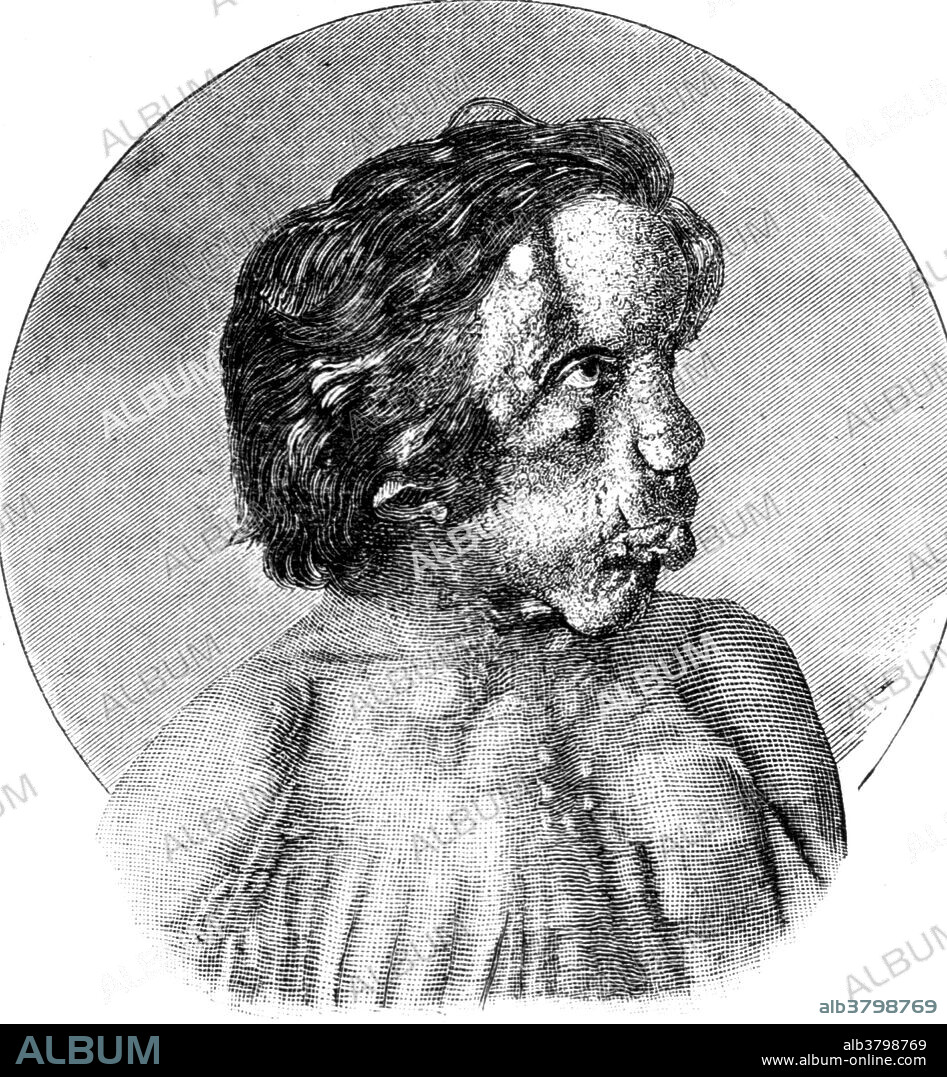 Joseph Carey Merrick (1862-1890) was an English man with severe deformities who was exhibited as a human curiosity named the Elephant Man. He became well known in London society after he went to live at the London Hospital. Although his condition was incurable, Merrick was allowed to stay at the hospital for the remainder of his life. English surgeon Frederick Treves visited him daily and the pair developed quite a close friendship. Merrick was originally thought to be suffering from elephantiasis. He died in 1890, aged 27. The official cause of death was asphyxia, although Treves, who dissected the body, said that Merrick had died of a dislocated neck. The exact cause of Merrick's deformities is unclear. The dominant theory was that Merrick suffered from neurofibromatosis type I. In 1986, a new theory emerged that he had Proteus syndrome. In 2001 it was proposed that Merrick had suffered from a combination of neurofibromatosis type I and Proteus syndrome. DNA tests conducted on his hair and bones have proven inconclusive.
