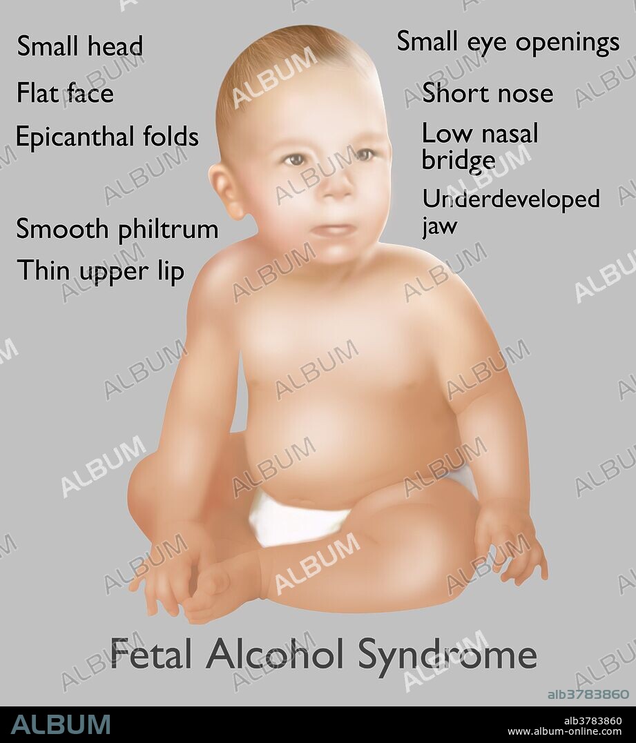 Illustration of baby with Fetal Alcohol Syndrome. Fetal Alcohol Syndrome or (FAS) is a condition in infants that is caused by alcohol consumption by the mother during time of pregnancy. Mental and physical defects such as a small head, flat face, epicanthal folds, smooth philtrum, thin upper lip, small eye openings, short nose, low nasal bridge, and underdeveloped jaw, are common symptoms of fetal exposure to alcohol.