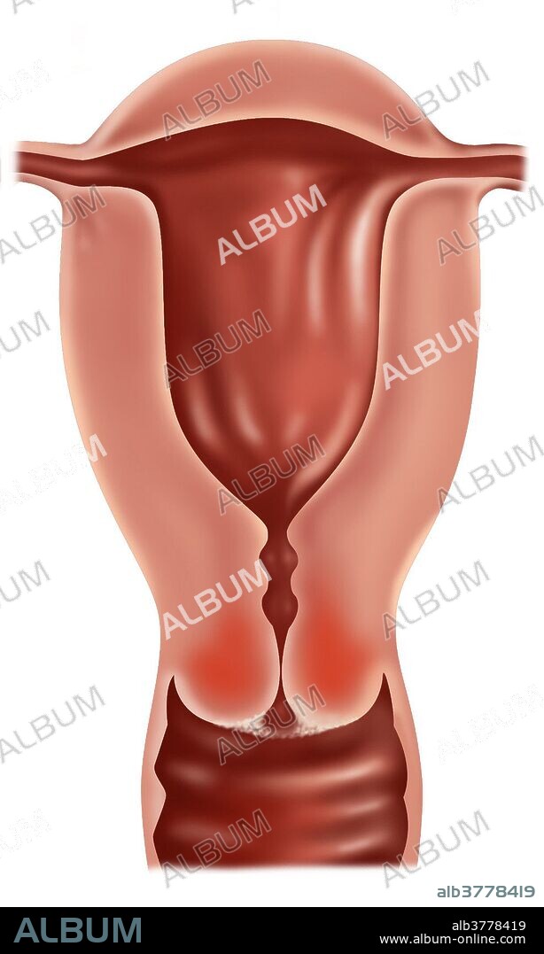 Medical illustration showing the cervix with early stage IB of cervical cancer. This stage is defined by clinically visible lesions, less than 4 centimeters across the greatest dimension, limited to the cervix uteri. Symptoms of cervical cancer include bleeding between periods, pain after sexual intercourse and heavier periods. Cancer of the cervix is rare and if detected early is almost always cured.