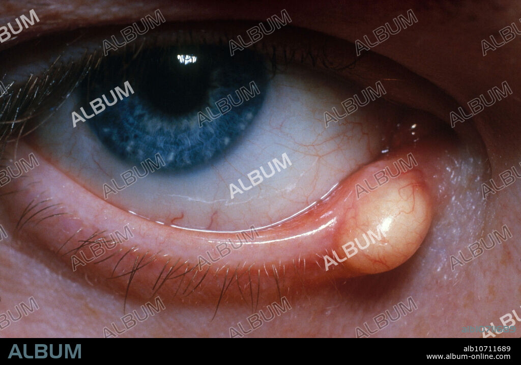 Pilomatricoma (also known as a Calcifying epithelioma of Malherbe,  Malherbe calcifying epithelioma,  Malherbe's tumor and Pilomatrixoma ), a cutaneous condition characterized by a benign tumor derived from the hair matrix.