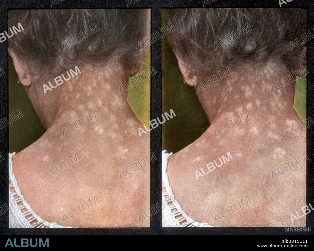 Vintage stereoscopic print from 1910, used to aid in the diagnosis and treatment of dermatological ailments. Shown is a female patient with a rash caused by the secondary stage of syphilis.