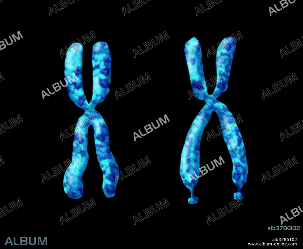 Illustration comparing a normal X chromosome (left) to a deformed X chromosome (right) associated with mental retardation known as fragile X syndrome. The extra portion dangling off the x chromosome is a genetic condition that causes a range of developmental problems including learning disabilities and cognitive impairment.