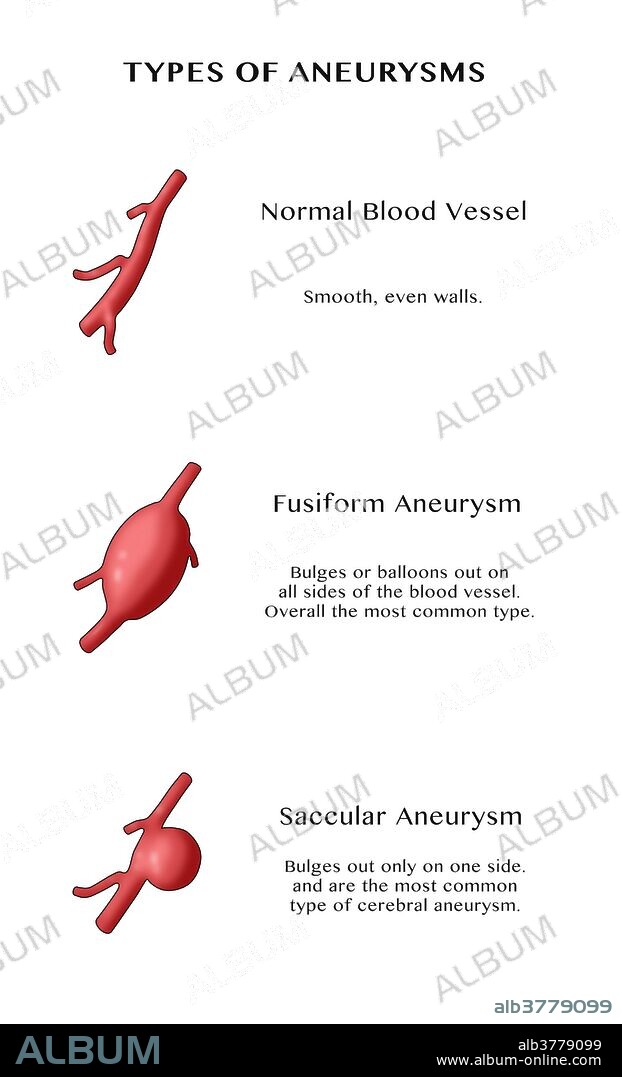Infographic comparing a normal blood vessel (top) with two types of aneurysms: a fusiform aneurysm (middle), which is the most common general type of aneurysm, where the blood vessel bulges out on all sides; and a saccular aneurysm (bottom), which is the most common type of cerebral aneurysm, where the blood vessel bulges out on only one side.