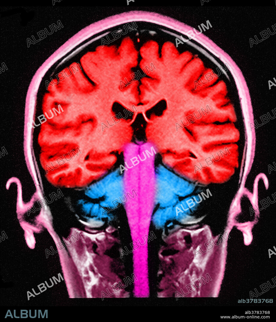 MRI of human brain, sagittal view.