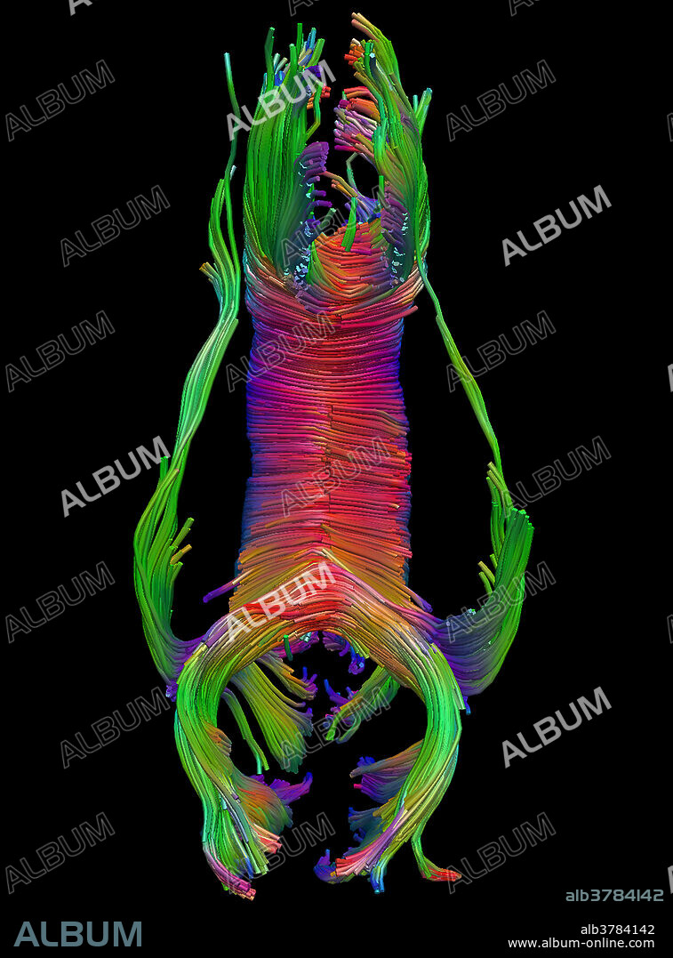 This inferior to superior view (looking from the feet to the top of the head, with the subject's nose towards the top of the image) colour image demonstrates the normal appearance of the corpus callosum which is the largest commissural tract in the brain, meaning it connects one side of the brain to the other. By convention the colour is coded so that blue indicates fibre tract direction in the superior (top) to inferior (bottom) direction, red indicates right to left (horizontal) fibre tract orientation and green indicates fibre tract directionality from anterior (front) to posterior (back).