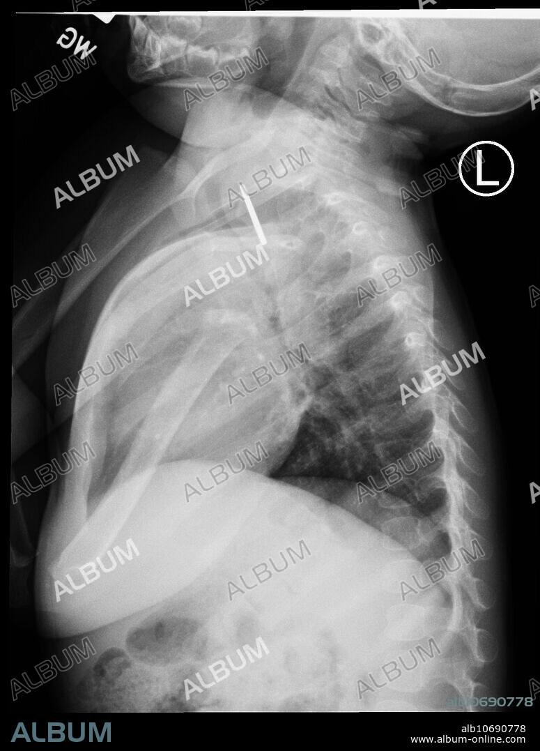 Lateral chest X-ray in 11 month old child reveals an ingested coin lodged in the upper thoracic esophagus.