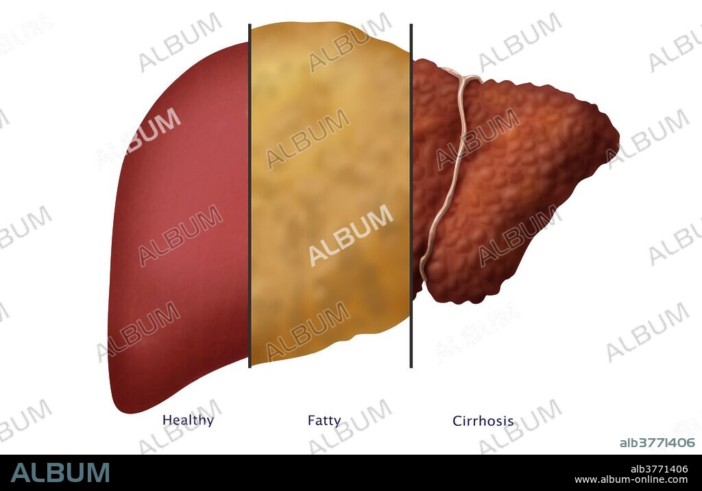 Illustration comparing the appearance of (left to right) a healthy, fatty, and cirrhotic liver. Fatty liver disease is a reversible condition where large vacuoles of triglyceride fat accumulate in liver cells via the process of steatosis (i.e., abnormal retention of lipids, or fat, within a cell). It is often the result of excessive alcohol intake and/or obesity. If left untreated, fatty liver disease can progress to cirrhosis, characterized by replacement of liver tissue by fibrosis, scar tissue and regenerative nodules (lumps that occur as a result of a process in which damaged tissue is regenerated), leading to loss of liver function. Cirrhosis is not reversible. Treatment focuses on slowing or stopping the progression of the disease. In severe cases, a liver transplant is necessary.