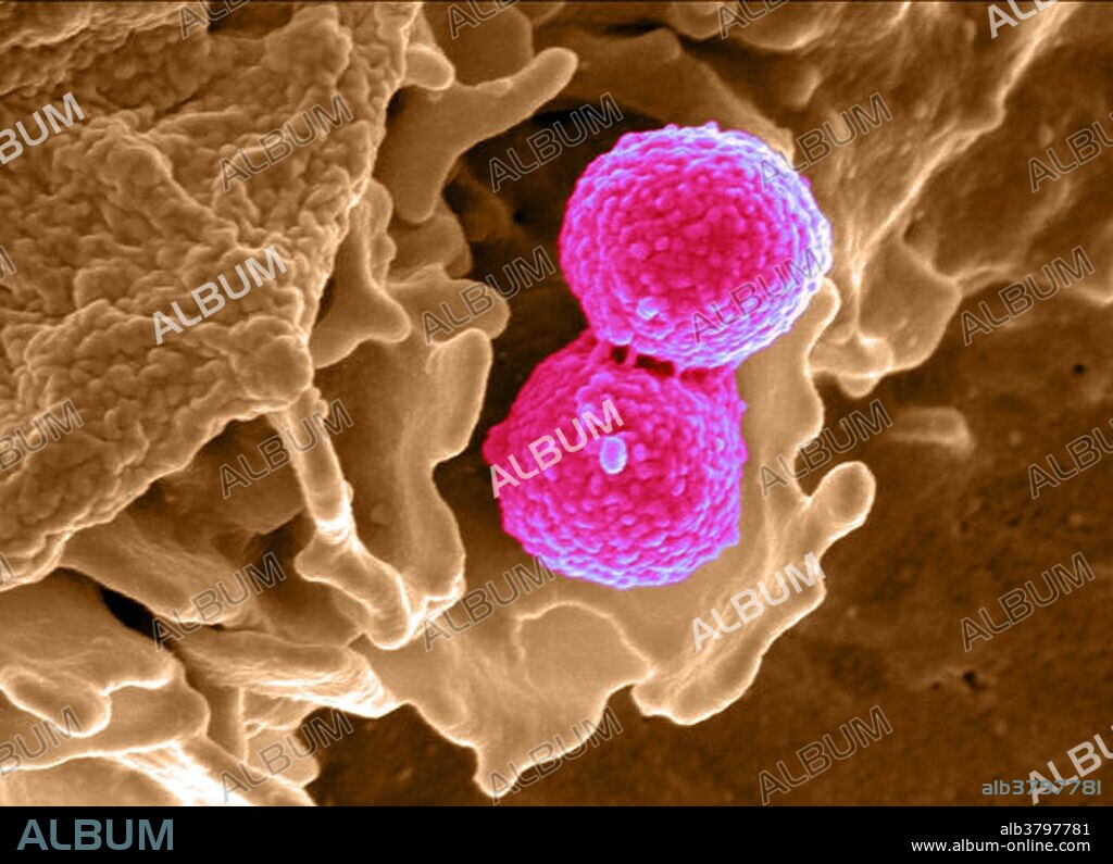 Color enhanced scanning electron micrograph of the interaction of MRSA bacteria with a human white cell. The bacteria shown is strain MRSA252, a leading cause of hospital-associated infections in the United States and United Kingdom. Methicillin-resistant Staphylococcus aureus (MRSA) is a bacterium responsible for several difficult-to-treat infections in humans. It is also called multidrug-resistant Staphylococcus aureus and oxacillin-resistant Staphylococcus aureus (ORSA). MRSA is any strain of Staphylococcus aureus that has developed resistance to beta-lactam antibiotics, which include penicillins and cephalosporins. Strains unable to resist these antibiotics are classified as methicillin-sensitive Staphylococcus aureus, or MSSA. The development of such resistance does not cause the organism to be more intrinsically virulent than strains of Staphylococcus aureus that have no antibiotic resistance, but resistance does make MRSA infection more difficult to treat with standard types of antibiotics and thus more dangerous. MRSA is especially troublesome in hospitals and nursing homes, where patients with open wounds, invasive devices, and weakened immune systems are at greater risk of infection than the general public.