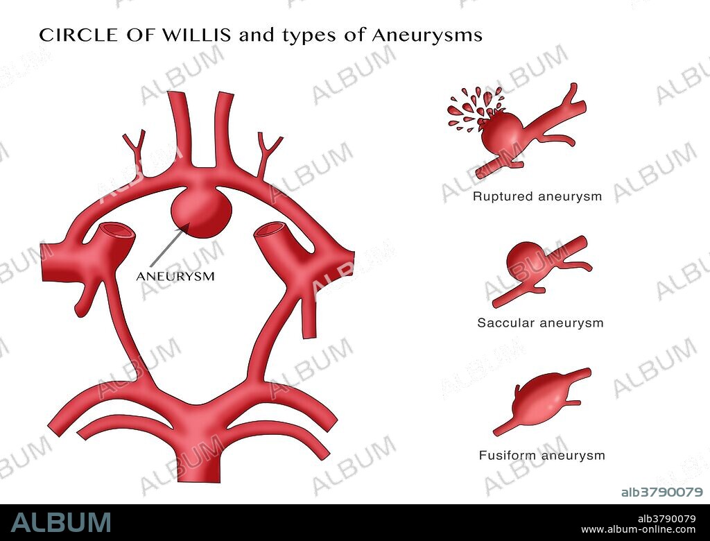 Aneurysm in the Circle of Willis, showing possible types (ruptured, fusiform, and saccular) at right. The circle of Willis (also called Willis' circle, loop of Willis, cerebral arterial circle, and Willis polygon) is a circulatory anastomosis that supplies blood to the brain and surrounding structures. It is named after Thomas Willis (1621-1675), an English physician.