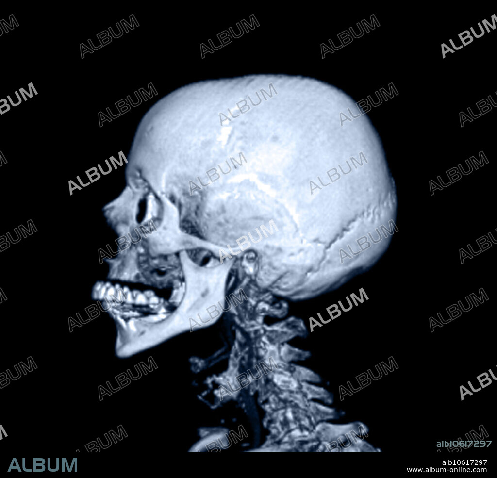 This 3D CT reconstruction of the skull beautifully demonstrates the coronal, temporal and lambdoid sutures. The skull sutures represent the juncture of the different membranous bones that form the skull. The coronal suture is the juncture between the frontal and parietal skull bones. The temporal suture seperates the parietal and temporal bones. The lamboid suture is the juncture between the parietal and occipital bones.