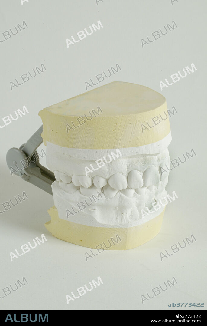 A dental study cast of upper and lower jaws. The cast is a positive reproduction of teeth and surrounding structures for the purpose of study and treatment planning created by pouring to allow an impression in plaster or stone.