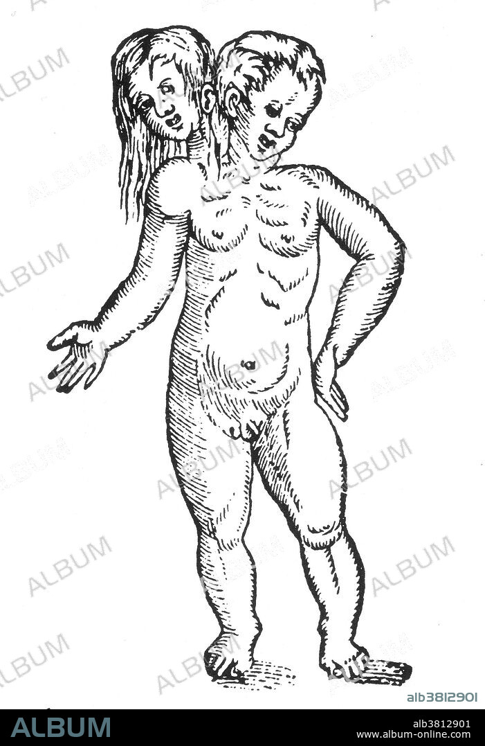 Woodcut of "a monster having two heads, one male and the other female" from Des Monstres et prodiges by Ambroise ParÃ©, 1573. Conjoined twins are identical twins born with their bodies joined at some point and having varying degrees of residual duplication, a result of the incomplete division of the ovum from which the twins developed. Parapagus twins are fused side-by-side with a shared pelvis. Twins that are dithoracic parapagus are fused at the abdomen and pelvis, but not the thorax. Twins that are diprosopic parapagus have one trunk and dicephalic. Twins that are dicephalic parapagus are dicephalic, and have two (dibrachius), three (tribrachius), or four (tetrabrachius) arms. Des Monstres is filled with unsubstantiated accounts of sea devils, marine sows, and monstrous animals with human faces. With its extensive discussion of reproduction and illustrations of birth defects, the book invited accusations of pornography.