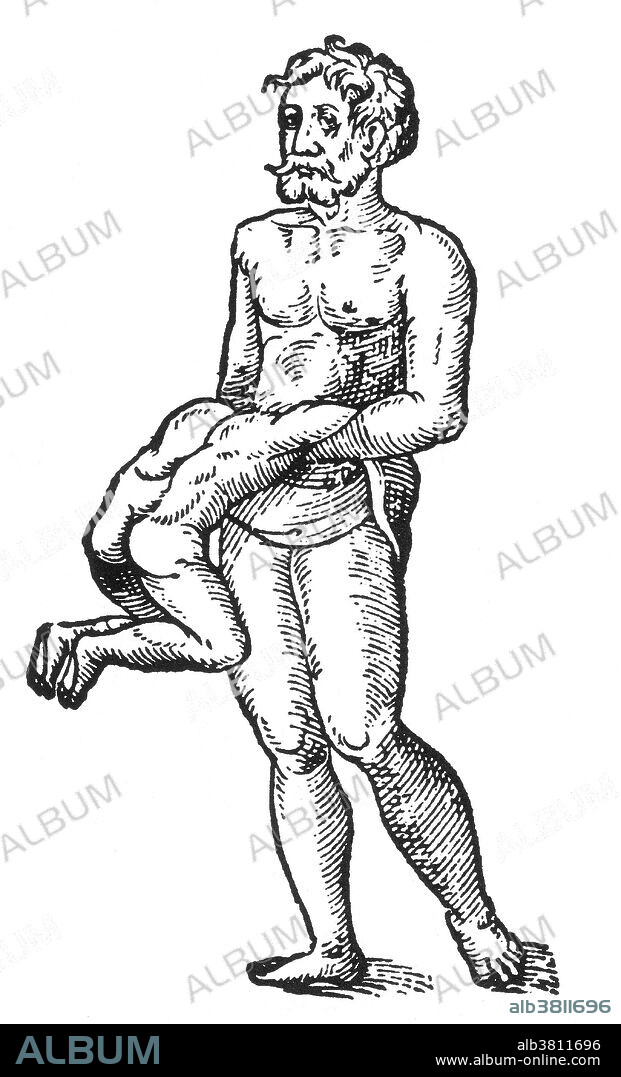 Woodcut of a "man from whose belly another man issued" from Des Monstres et prodiges by Ambroise ParÃ©, 1573. A parasitic twin (also known as an asymmetrical or unequal conjoined twin) is the result of the processes that produce vanishing twins and conjoined twins, and may represent a continuum between the two. Parasitic twins occur when a twin embryo begins developing in utero, but the pair does not fully separate, and one embryo maintains dominant development at the expense of the other. Unlike conjoined twins, one ceases development during gestation and is vestigial to a mostly fully formed, otherwise healthy individual twin. The undeveloped twin is defined as parasitic, rather than conjoined, because it is incompletely formed or wholly dependent on the body functions of the complete fetus. The independent twin is called the autosite. Des Monstres is filled with unsubstantiated accounts of sea devils, marine sows, and monstrous animals with human faces. With its extensive discussion of reproduction and illustrations of birth defects, the book invited accusations of pornography.