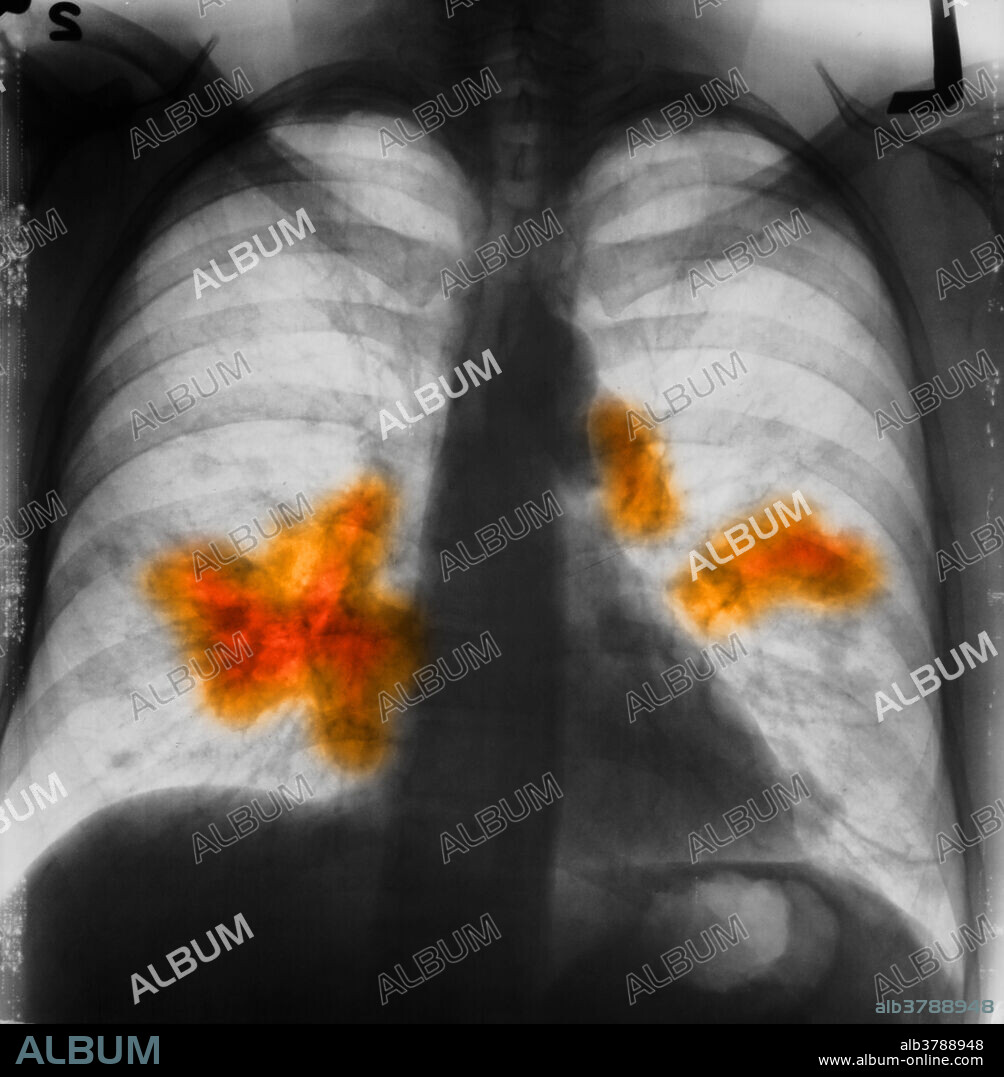 This is an x-ray image of a chest. Both sides of the lungs are visible with a growth on the left side of the lung, which could possibly be lung cancer. Lung cancer, also known as carcinoma of the lung or pulmonary carcinoma, is a malignant lung tumour characterized by uncontrolled cell growth in tissues of the lung. If left untreated, this growth can spread beyond the lung by process of metastasis into nearby tissue or other parts of the body. Most cancers that start in the lung, known as primary lung cancers, are carcinomas that derive from epithelial cells. This image has been colourized.