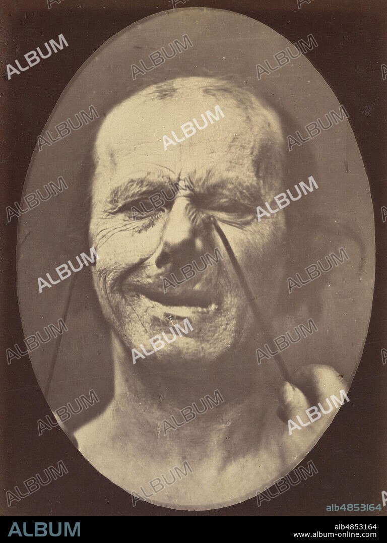 DUCHENNE DE BOULOGNE and ADRIEN ALBAN TOURNACHON. Figure 53: Whimpering and false laughter, 1854-56, printed 1862.