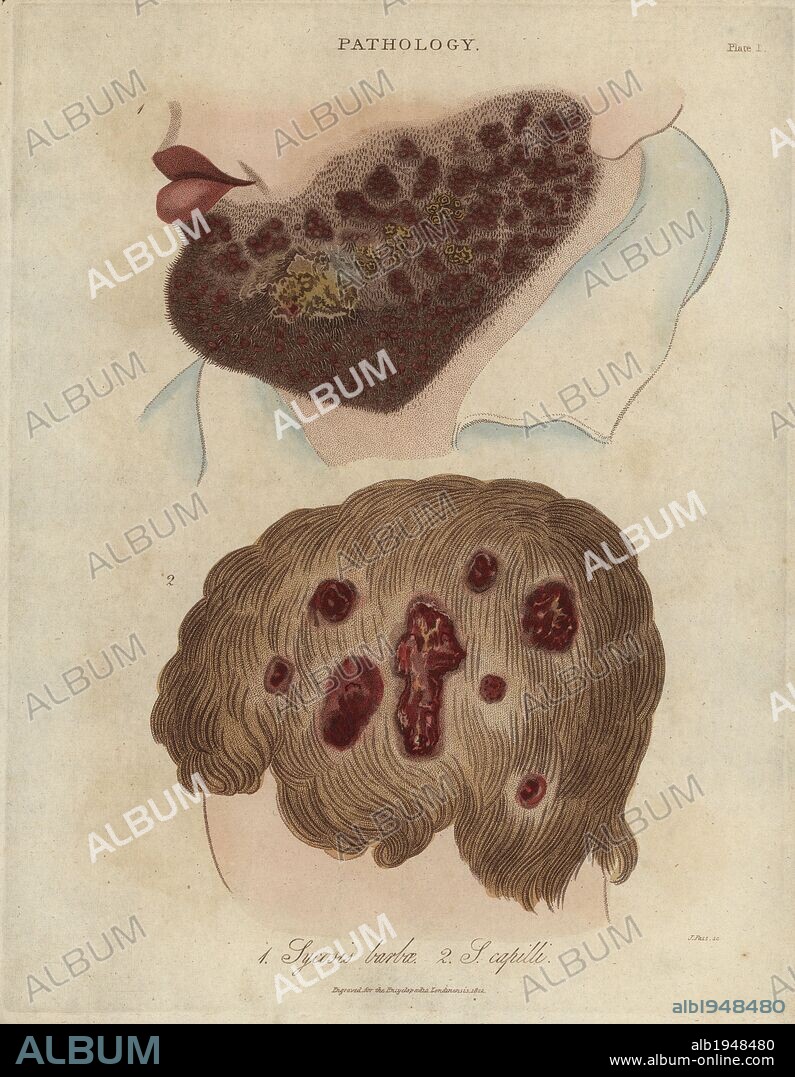 Sycosis barbae and Sycosis capilli, chronic inflammation of the hair follicles, especially of the beard and head. Handcoloured copperplate stipple engraving by John Pass from John Wilkes' "Encyclopedia Londinensis," J. Adlard, London, 1822.