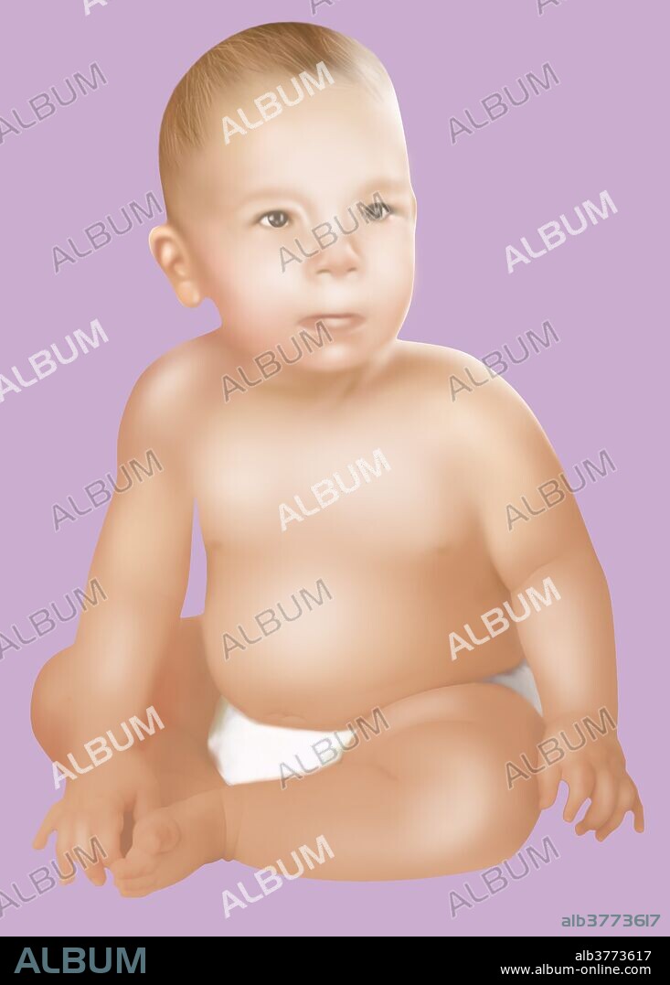 Illustration of baby with Fetal Alcohol Syndrome. Fetal Alcohol Syndrome or (FAS) is a condition in infants that is caused by alcohol consumption by the mother during time of pregnancy. Mental and physical defects such as a small head, flat face, epicanthal folds, smooth philtrum, thin upper lip, small eye openings, short nose, low nasal bridge, and underdeveloped jaw, are common symptoms of fetal exposure to alcohol.