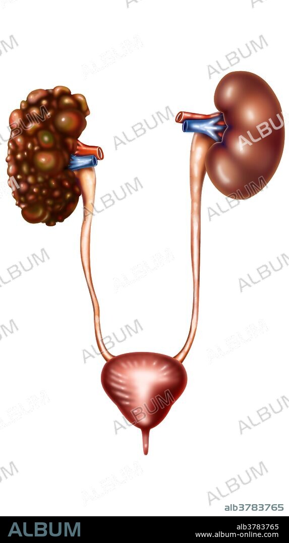 Polycystic kidney disease (PKD or PCKD, also known as polycystic kidney syndrome) is a cystic genetic disorder of the kidneys. There are two types of PKD: autosomal dominant polycystic kidney disease and the less-common autosomal recessive polycystic kidney disease. PKD is characterized by the presence of multiple cysts. The cysts are numerous and are fluid-filled, resulting in massive enlargement of the kidneys. The disease can also damage the liver, pancreas and, in some rare cases, the heart and brain. The two major forms of polycystic kidney disease are distinguished by their patterns of inheritance.