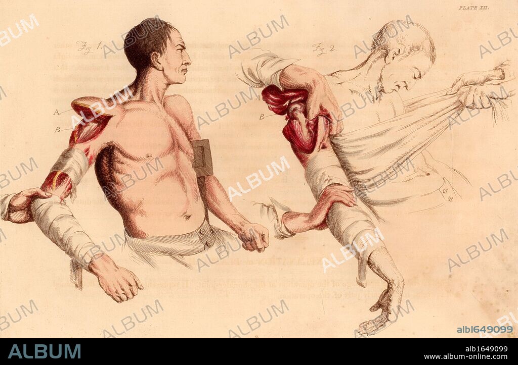 Amputation of the arm at the shoulder. On the left the incision has been made, exposing the head of the humerus. On the left the flap has been enlarged and the head of the humerus dislocated. From "Illustrations of the Great Operations of Surgery" by Charles Bell (London, 1821). Hand-coloured engraving. (Photo by: Universal History Archive/UIG via Getty Images).