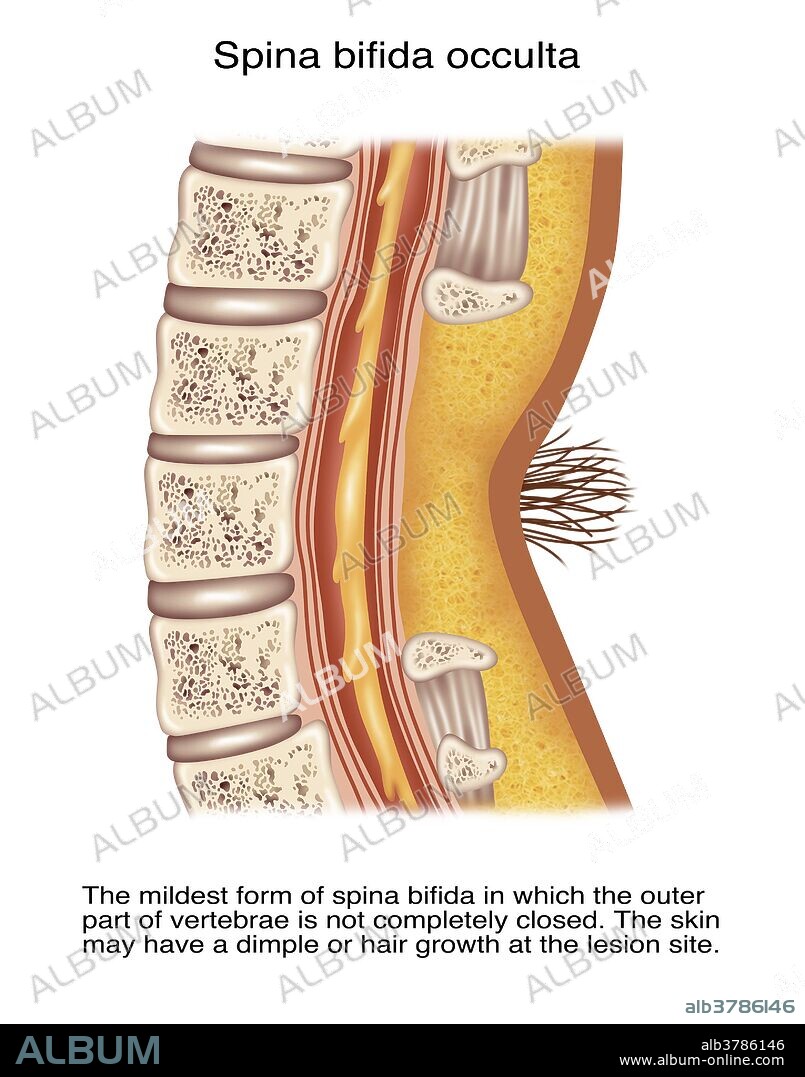Illustration of spina bifida occulta. Spina bifida occulta is the mildest form of spina bifida in which the outer layer part of vertebrae is not completely closed. The skin may have a dimple or hair growth at the lesion site.