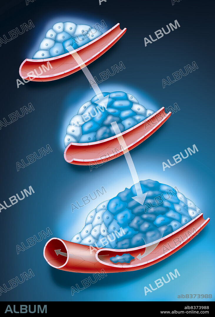 Representation of the development of the cancerous tumor.. Step 1 the tumor is still small.. Step 2 the tumor has grown, the cancer cells have multiplied and transformed.. Step 3 the tumor has grown again. The cells with irregular nuclei are mature cancer cells (metastases) that will follow the vascular network to spread in other parts of the body.
