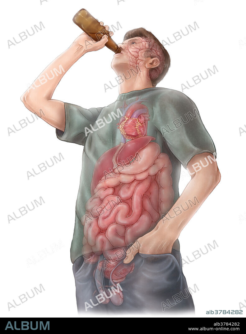 An illustration depicting the effects of alcohol consumption on major organs in the body. Alcohol abuse can result in long term affects on the brain such as damaged neurons, impaired memory and personality disorders, along with short term affects such as loss of motor coordination and cognitive function. Long term drinking also affects heart health, resulting in conditions such as alcoholic cardiomyopathy, arrhythmia, coronary heart disease, strokes and high blood pressure. The liver eventually becomes damaged from filtering alcohol out of the blood, resulting in conditions such as cirrhosis which can eventually lead to liver failure. Alcohol abuse also increases the risk of stomach ulcers, inflammation and cancer within the digestive tract. Alcohol also has a diuretic effect, which increases urine volume and fluid loss. Both men and women's reproductive health may be affected by long term alcohol abuse with altered hormone levels, impotence in men.