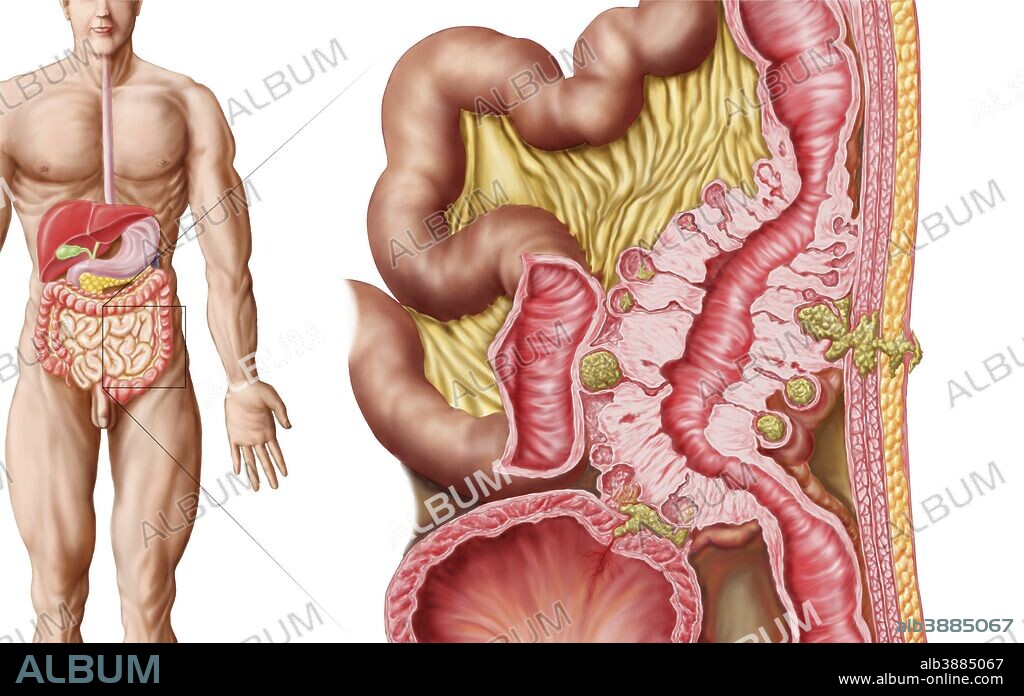 Illustration of diverticulosis in the colon. Diverticulitis is a common digestive disease which involves the formation of pouches (diverticula) within the bowel wall. This process is known as diverticulosis, and typically occurs within the large intestine, or colon. Diverticulitis results when one of these diverticula becomes inflamed.