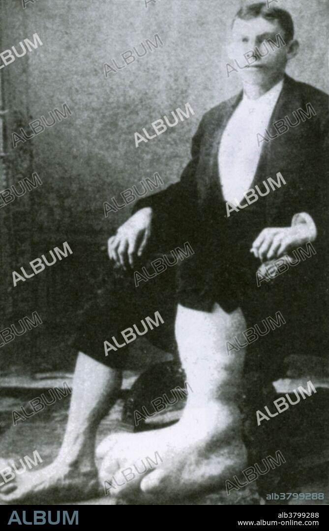 Eugene Berry (born 1872), also known as the Ohio Big Foot Boy. Berry had either elephantitis or Milroy's disease, giving him a giant and deformed leg. He toured the country, exhibiting himself at Doris's Eighth Avenue Museum in New York and the oddity hall at the Harlem Museum, among other places. Undated photograph.