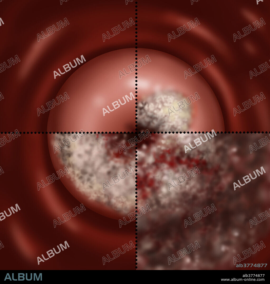 Illustration showing the progression of cervical cancer. Upper left section shows a normal cervix. Upper right section shows the early stage IB of cervical cancer. This stage is defined by clinically visible lesions, less than 4 centimetres across the greatest dimension, limited to the cervix uteri. Lower left shows the late stage IB of cervical cancer, defined by a clinically visible lesion greater than 4 centimetres across its widest dimension. Lower right section shows IIB cervical cancer. This is an advanced stage of the cancer, with extension to the pelvic wall, as seen here. This stage can also result in hydronephrosis (non-functioning kidney). Symptoms of cervical cancer include bleeding between periods, pain after sexual intercourse and heavier periods. Cancer of the cervix is rare and if detected early is almost always cured.