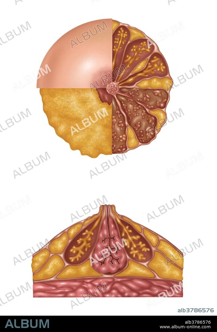 Illustration detailing the anatomy of a female breast from a front view (top) and a side view (bottom). The top image is in three sections. The areola, montgomery's tubercules, and nipple are in the light pink section. The nipple and subareolar musculature and subcutaneous fat are in the orange section. On the right half is: mammary fat (orange), lactiferous ducts (orange stems), acini (end of orange stems), ampulla (on orange stem), coopers ligaments (light pink strands), lobe and lobules (brown outlines and pink groups inside the brown), and interlobular connective tissue (brown area). The bottom image shows montgomery's gland and superficial fascia (outer lining), subcutaneous fat (orange outer sections), ampulla and lactiferous duct and connective tissue (pink center), coopers ligaments, mammary fat (orange bottom sections), pectoral fascia, and pectoralis major (pink at bottom).