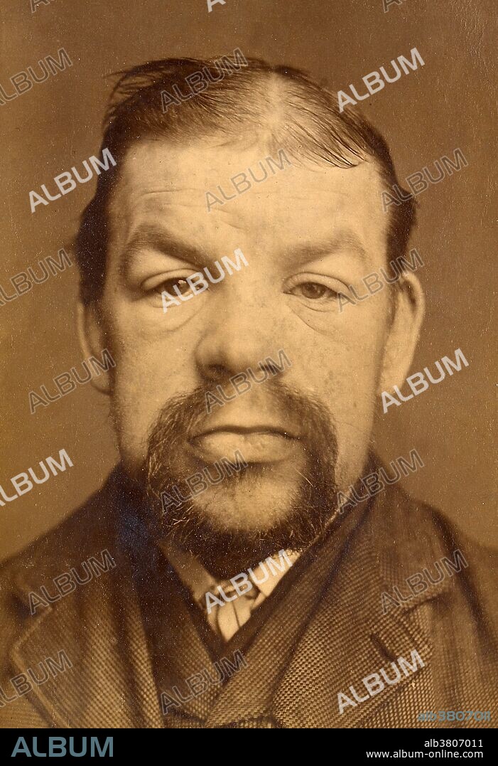 Face of a man with myxoedema. Myxedema or myxoedema is a term used synonymously with severe hypothyroidism; however, the term is also used to describe a dermatological change that can occur in hypothyroidism and some forms of hyperthyroidism. In this context, myxedema refers to deposition of mucopolysaccharides in the dermis, which results in swelling of the affected area. Caption with image, from 1886: "The face presents the stolid appearance which is characteristic of the disease. The hair of the head is thin and scanty, whilst the skin of the forehead is thickened and of a yellowish hue. The eyebrows are very arched. The eyelashes are thin, and the eyelids are puffy, transversely wrinkled and pearly in aspect. The root of the nose is broad and thick. The alae nasi are thick and fixed. The lips are thick and of a purplish hue. The tongue was broad and thick, the gums thickened and lobulated. The teeth were loose, the thyroid not perceptible.".