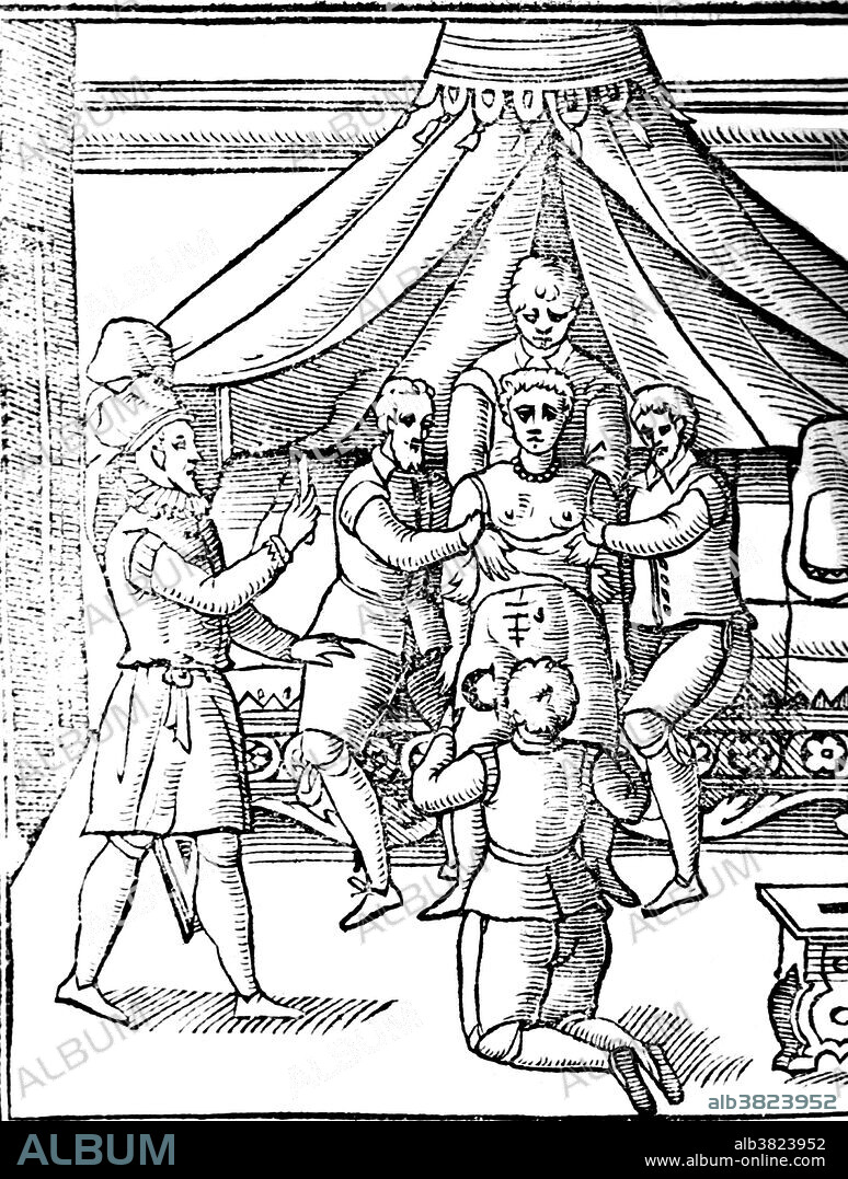 A woodcut from 1601. Four male assistants prepare a woman for a cesarean section; the physician stands to the left holding a razor; there is a prominent scar on the woman's abdomen suggesting that this is not her first cesarean. The Roman Lex Regia of Numa Pompilius (715-673 BC), required that the child of a mother dead in childbirth be cut from her womb, a religious requirement that mothers not be buried pregnant, that evolved into a way of saving the fetus when it was realized the woman could not survive the delivery. Speculation that Julius Caesar was born by the method is false. A Caesarean section is a surgical procedure in which one or more incisions are made through a mother's abdomen and uterus to deliver one or more babies. A Caesarean section is usually performed when a vaginal delivery would put the baby's or mother's life or health at risk.