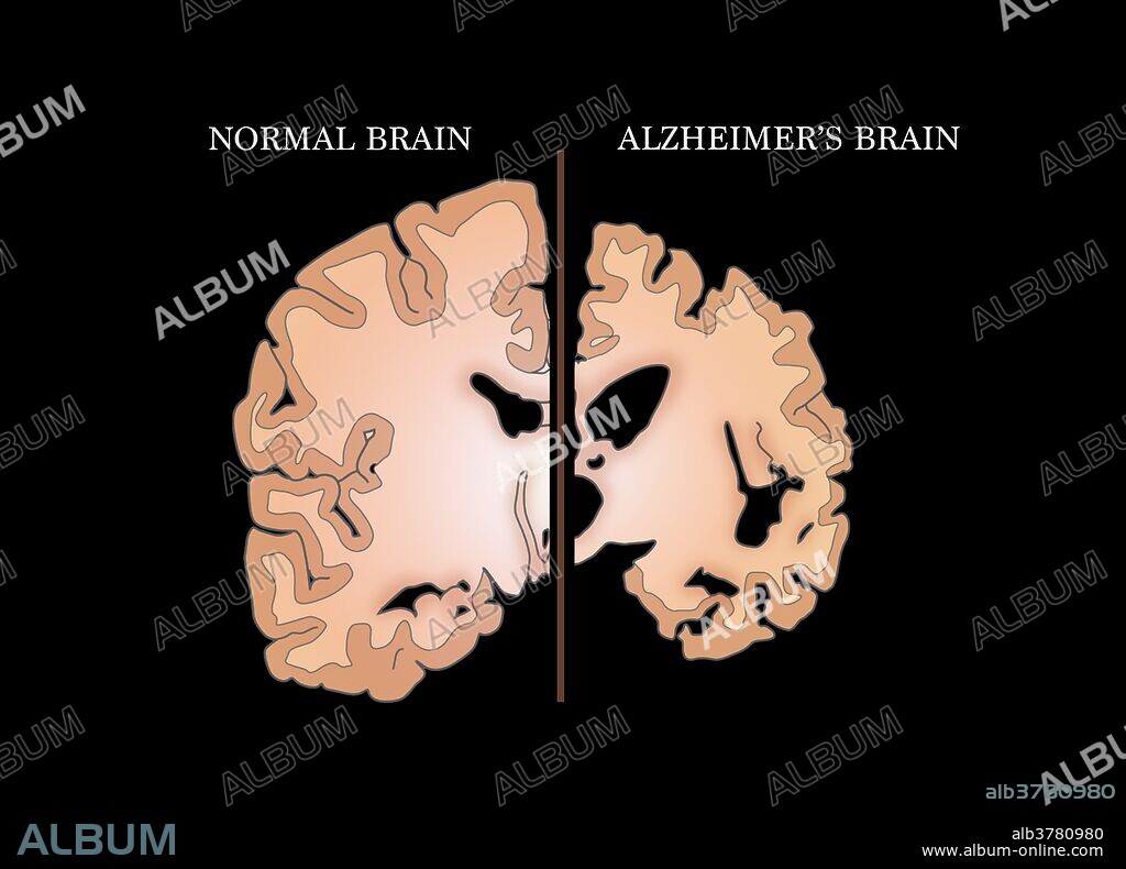 Illustration comparing a normal brain (left) with a brain suffering from Alzheimer's disease (right).