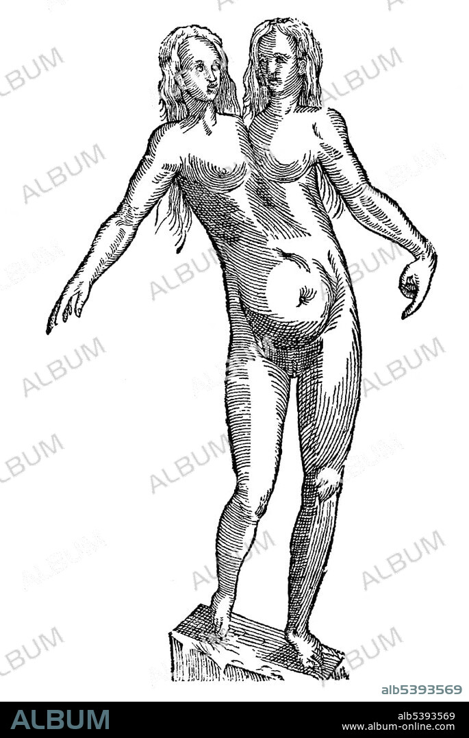 Woodcut, Icon puellae biciptis, siamese twins, taken from Aldrovandi, Historia Monstrorum 1642, 17th century, Renaissance