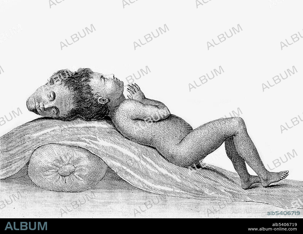 The so-called "Two-Headed Boy of Bengal" was born in 1783 and died of a cobra bite in 1787. His skull remains in the collection of the Hunterian Museum of the Royal College of Surgeons of London. Craniopagus parasiticus is an extremely rare type of parasitic twinning occurring in about 4 to 6 of 10,000,000 births. In craniopagus parasiticus, a parasitic twin head with an undeveloped body is attached to the head of a developed twin. Fewer than a dozen cases of this type of conjoined twin have been documented in history Most infants with this condition are stillborn, or die shortly after birth. Only ten cases of craniopagus parasiticus have been reported in the medical research literature. Of those cases, only three have survived birth.