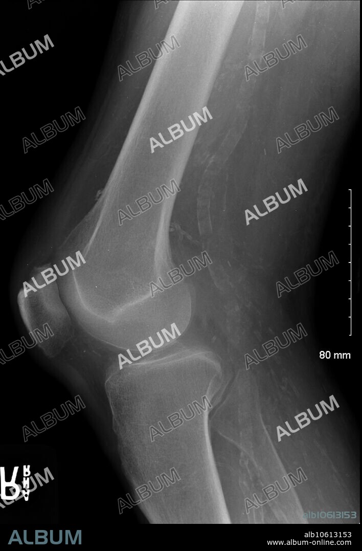 Lateral knee X-ray showing dense calcification of popliteal artery and small artery branches in 68 yo dialysis patient with chronic renal failure and secondary hyperparathyroidism.