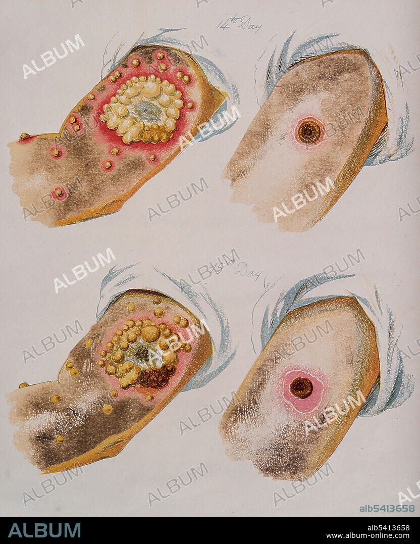 A comparison between smallpox and cowpox pustules on the 14th and 15th day of the disease. Cowpox (orthopoxvirus family) is an infectious disease caused by the cowpox virus. The virus is zoonotic, meaning that it is transferable between species, such as from animal to human. The transferral of the disease was first observed in dairymaids who touched the udders of infected cows and consequently developed the signature pustules on their hands. Cowpox is similar to, but much milder than, the highly contagious and often deadly smallpox disease. Its close resemblance to the mild form of smallpox and the observation that dairy farmers were immune from smallpox inspired the first smallpox vaccine, created and administered by English physician Edward Jenner. Once vaccinated, a patient develops antibodies that make them immune to cowpox, but they also develop immunity to the smallpox virus, or Variola virus. Chromolithograph, after George Kirtland, 1896.