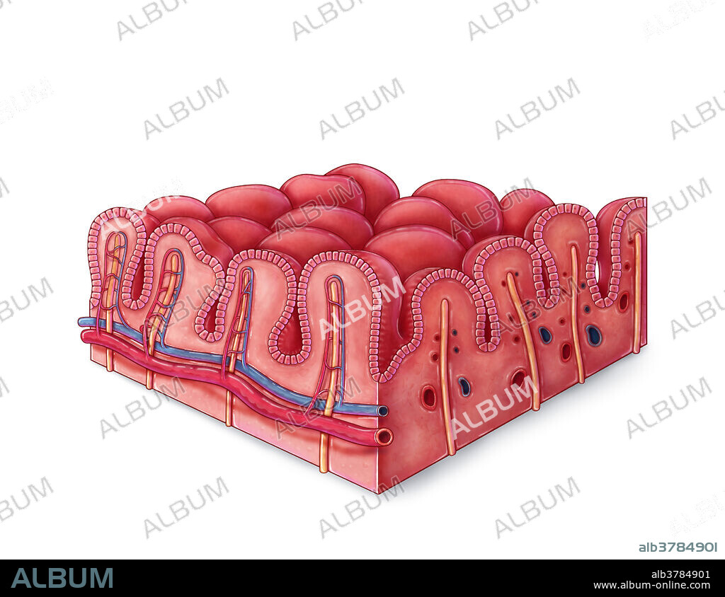 An illustrated section of villi of the small intestine affected by celiac disease. Intestinal villi are finger-like projections extending into the lumen of the small intestine, increasing surface area and aiding nutrient absorption. Capillaries and lacteals (lymph vessels) extend into each villus to collect broken down sugars, amino acids, and fats that diffuse through the epithelium. Celiac disease is an autoimmune disorder caused by the body's reaction to a protein found in wheat and grains, known as gluten. When celiac patients consume gluten, the immune system releases antibodies and creates an inflammatory response, resulting in symptoms like diarrhoea, abdominal pain, loss of appetite, and other gastrointestinal problems. Inflammation and damage caused by the immune response can result in blunting of the intestinal villi, hindering absorption and often leading to complications like anaemia or malnutrition.
