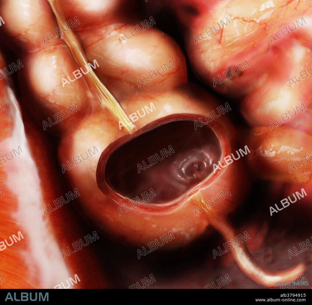 Anterior view of the cecum and appendix. The cecum is cut to reveal its inner texture and the illeocecal valve, the structure that connects the distal end of the small intestine (ileum) with the proximal end of the colon (cecum). Attached to the cecum is the veriform appendix, a mass of lymphoid tissue that defends the area against bacteria.