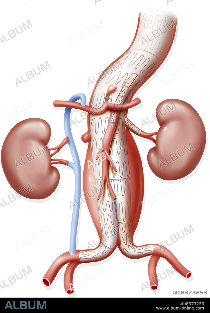 Illustration of surgery for an abdominal aortic aneurysm with placement of an endoprosthesis in the aorta. A stent is also placed in the superior mesenteric artery, as well as a fenestra and covered stent in the left renal artery. The right renal artery, showing early bifurcation is ligatured and a bypass with the saphenous vein is set up between the right common iliac artery and the hepatic artery to reestablish blood flow in the right kidney.