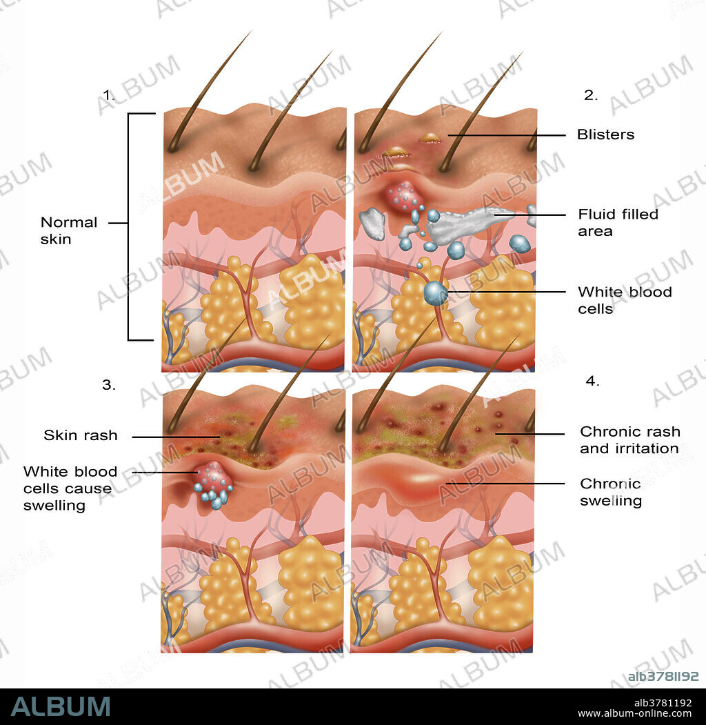 Cross-section illustration of the formation of eczema on the skin in four parts. From top left to bottom right: normal skin, blisters and skin becomes itchy, the rash transitions from acute to chronic becoming flaky, and finally the rash becomes chronic and itchy. Topical steroids and ointments are used to ease the discomfort of the eczema rash.