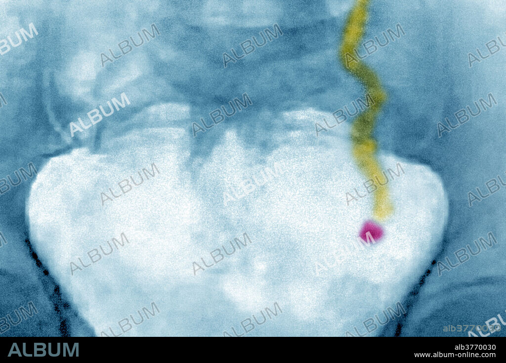 X-ray of the pelvis, showing renal colic caused by urolithiasis in the left ureter. Colour-enhanced image.