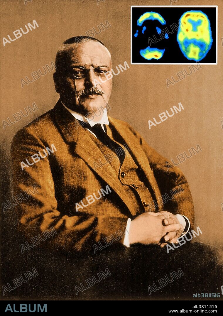 Alois Alzheimer (1864-1915). In 1906, German psychiatrist and neuropathologist Alois Alzheimer made a complete clinical and pathological description of presenile dementia, which came to be known as Alzheimer's disease, a progressive condition in which nerve cells in the brain degenerate. Inset image showing PET scans of a normal human brain (right) and one afflicted with Alzheimer's disease (left).