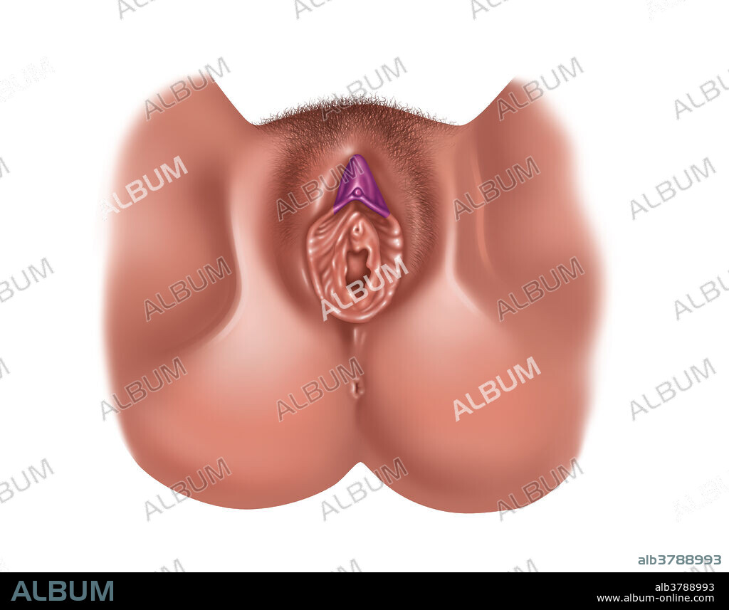 Illustration of a clitoridectomy. One of various methods of ritual removal of some or all of the female genitalia. These procedures are performed by a traditional circumciser using a blade or razor, with or without anaesthesia. Female genital mutilation has been outlawed or restricted in most of the countries in which it occurs. It is rarely done as a therapeutic medical procedure, such as when cancer has developed in or spread to the clitoris.
