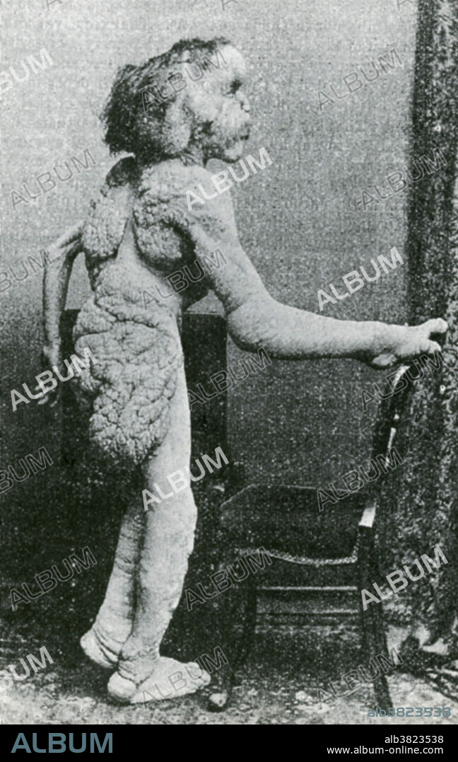 Joseph Merrick, 'the Elephant man' (1862-1890), whom the British surgeon Frederick Treves (1853-1923) rescued and maintained in a room in the London Hospital from 1886 until Merrick's death in 1890. Joseph Merrick was originally thought to be suffering from elephantiasis, though others have posited neurofibromatosis type I, also known as von Recklinghausen disease. Proteus syndrome has also been suggested as a possibility.