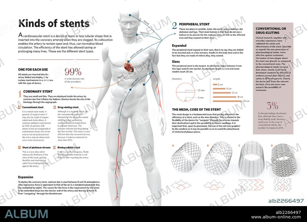 Tipos de stent. Infografía del estent cardiovascular (dispositivo que se introduce en las arterias cuando éstas están obstruidas) y de los tipos de estent que existen.