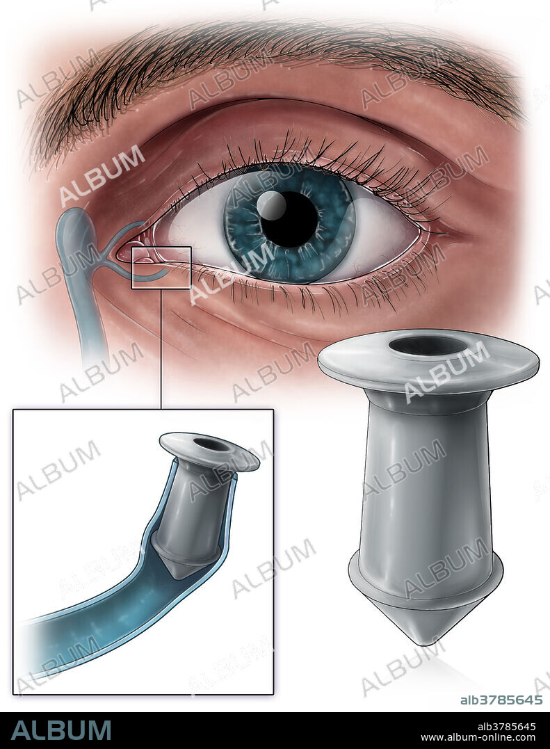 An illustration of a punctal plug, a medical device inserted into the tear duct (puncta) of the eye to prevent the drainage of liquid in order to treat patients suffering from dry eye.