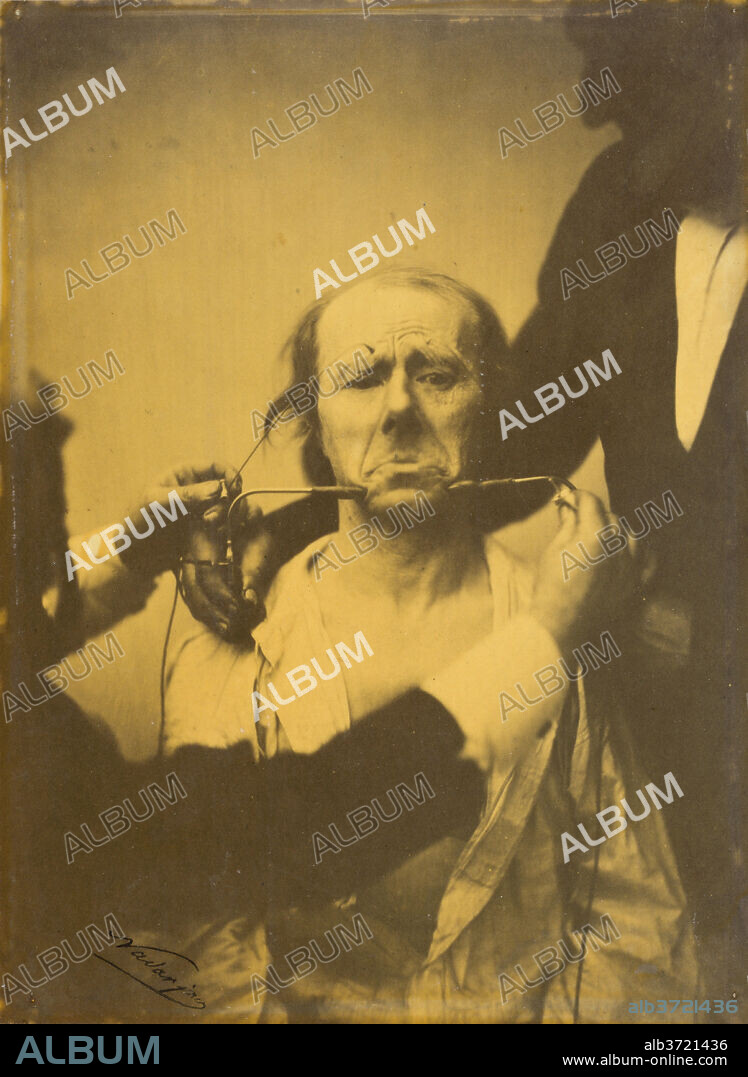 GUILLAUME-BENJAMIN-AMANT DUCHENNE (DE BOULOGNE), FRENCH, 1806-1875, AND ADRIEN TOURNACHON, FRENCH, 1825-1903. Pain and despair, plate 45 from the album, The Mechanism of Human Facial Expression. Dated: 1854-1856. Dimensions: image: 22.3 × 16.4 cm (8 3/4 × 6 7/16 in.)  mount: 40.2 × 27.7 cm (15 13/16 × 10 7/8 in.). Medium: albumen print, printed 1862.